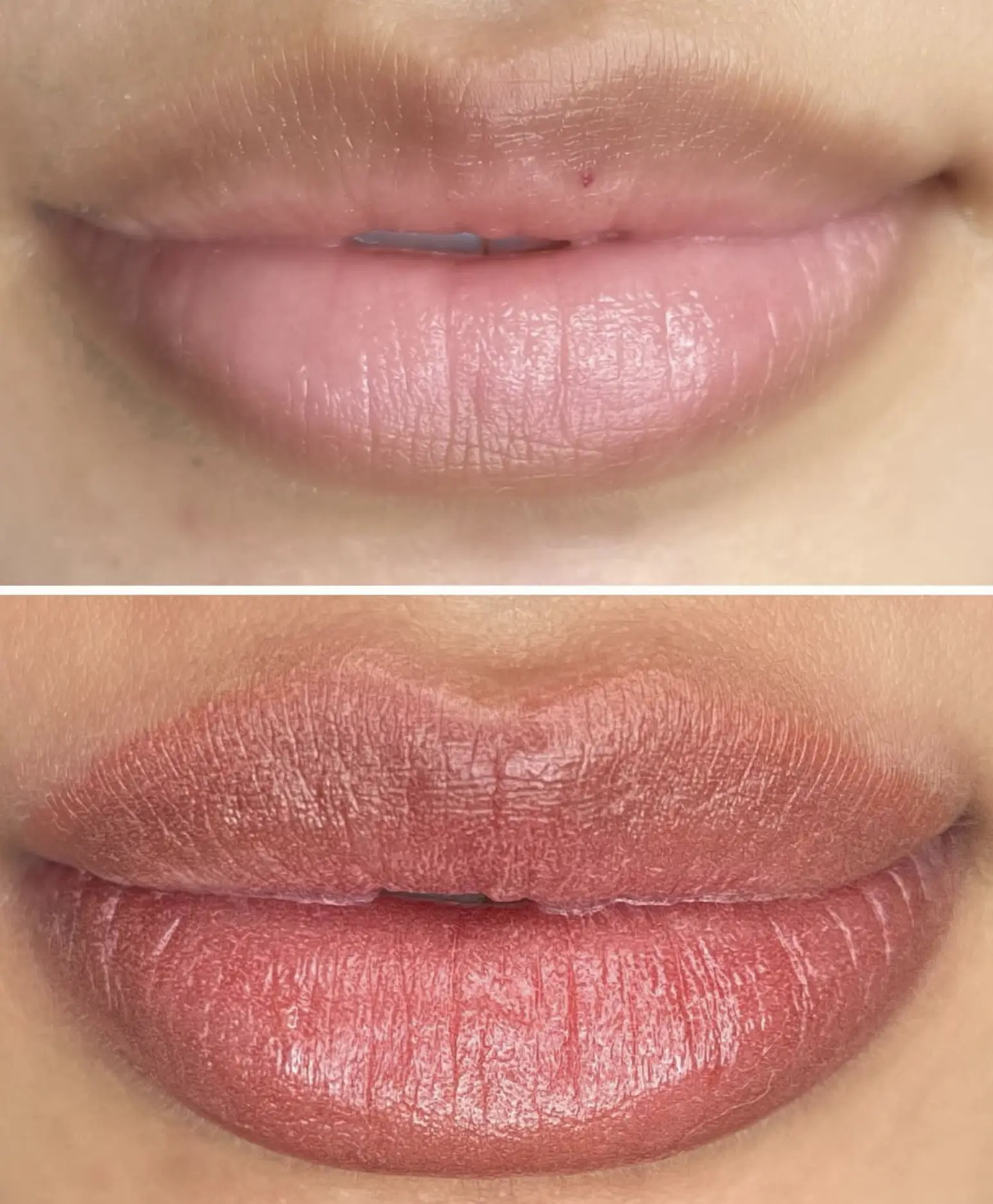 lip neutralization near me